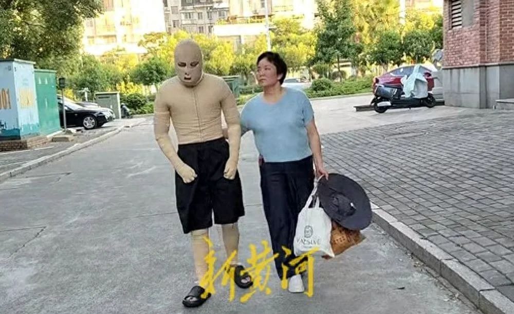 Battery Exploded — 90% of His Body Burned!
