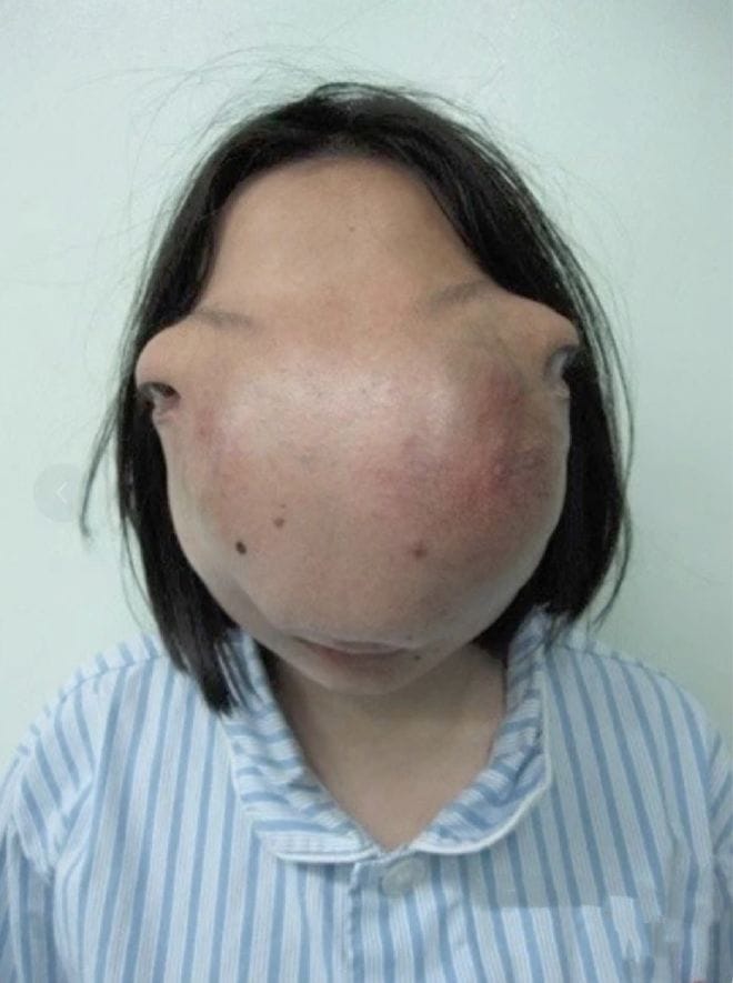 Girl Hid Her Face for 13 Years; Risky Surgery Restored Her Looks—But Her Mother Never Lived to See It