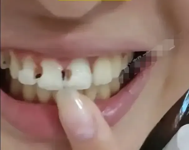 Woman Loses 8 Teeth After 5 Years with Braces
