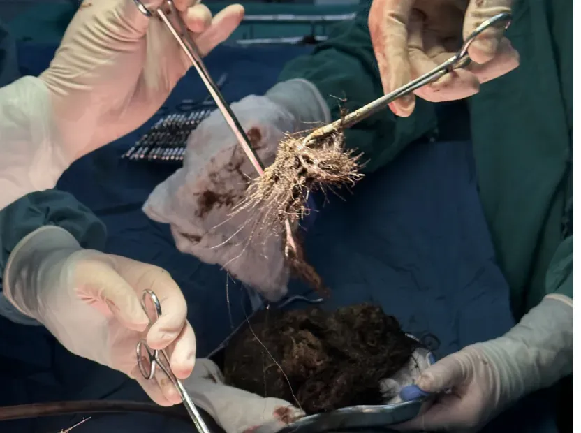15-Year-Old Diagnosed with 4-Pound “Stone” Removed from Stomach!