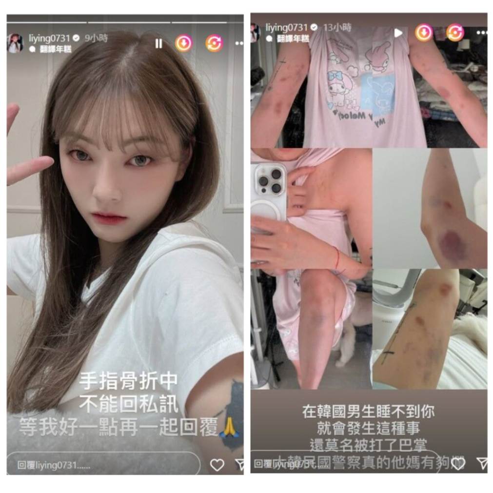 YouTuber Attacked in Korea for Refusing Overnight Request, Suffers Fractured Finger