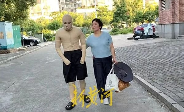 Battery Exploded — 90% of His Body Burned!