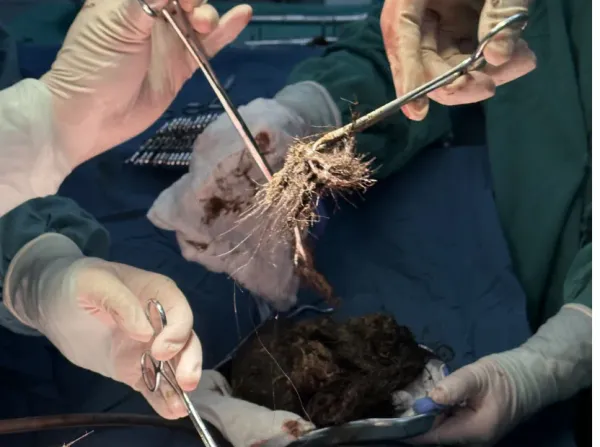 15-Year-Old Diagnosed with 4-Pound “Stone” Removed from Stomach!