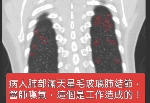 Woman Found with “Starry Sky” Lung Nodules—Doctor Sighs: Caused by Her Job