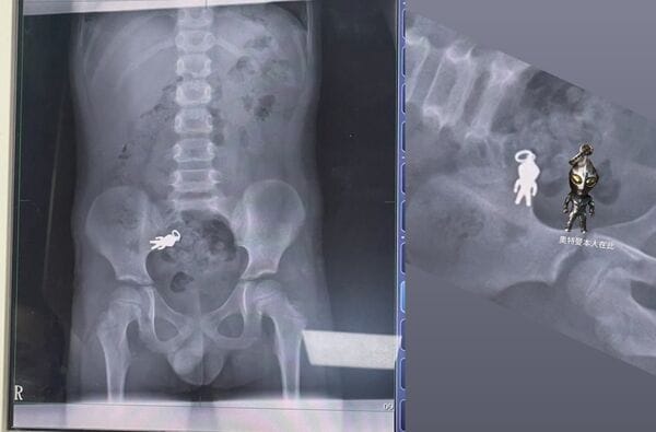 7-Year-Old Accidentally Swallows Ultraman Keychain—X-Ray Shows the Hero Intact
