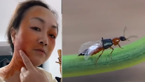 Toxic Rove Beetles Invade Jinan: Residents Suffer Painful Skin Burns from “Flying Acid”